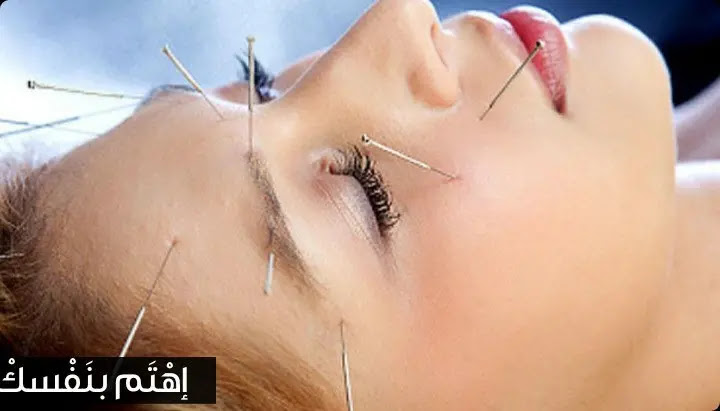 العلاج بالإبر الصينية 